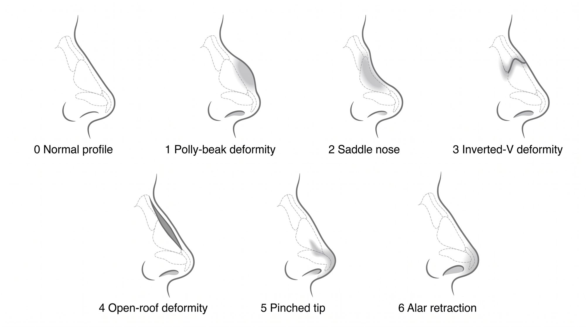 A normal profile and six post-rhinoplasty deformities: polly-beak, saddle nose, inverted-V, open roof, pinched tip, alar retraction
