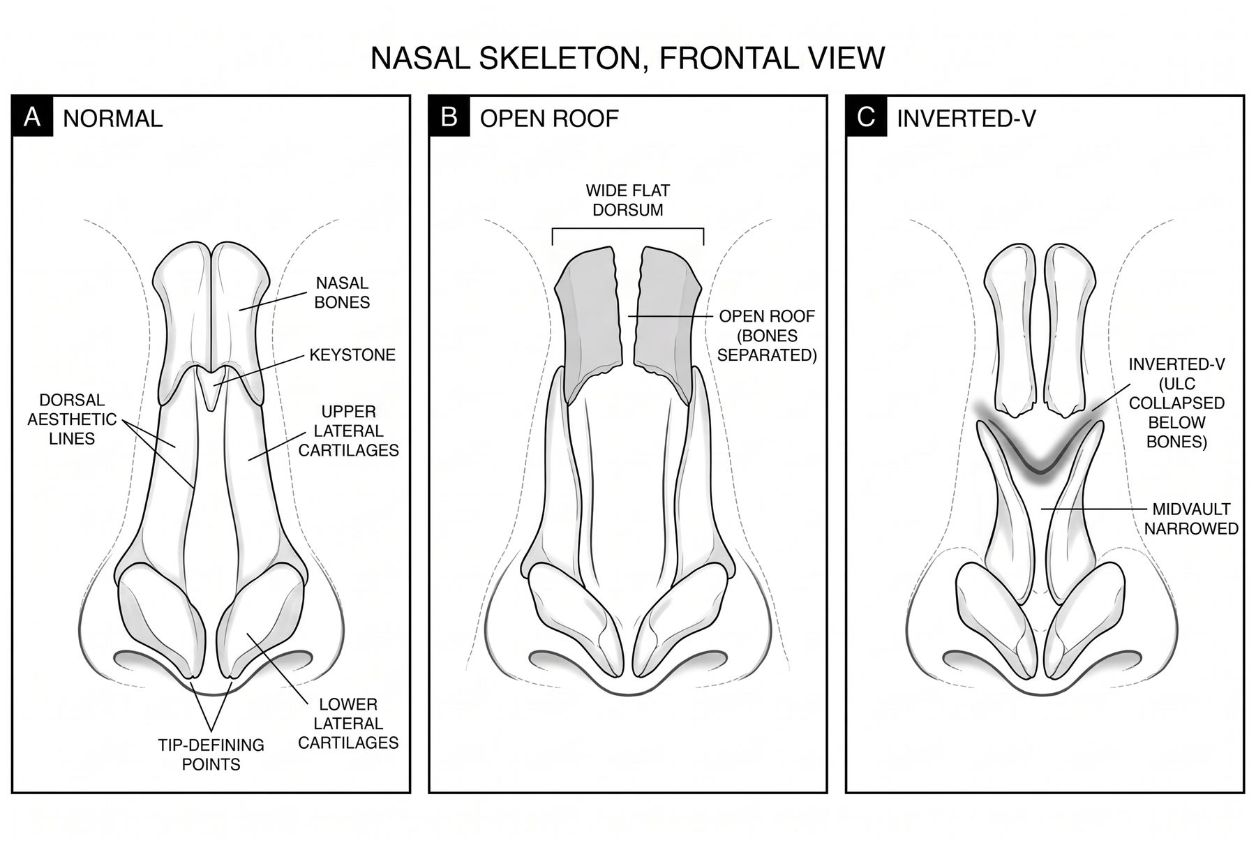 Frontal view of the nasal skeleton: normal dorsal aesthetic lines and keystone, the open roof with the nasal bones separated, and the inverted-V with the upper lateral cartilages collapsed below the bones