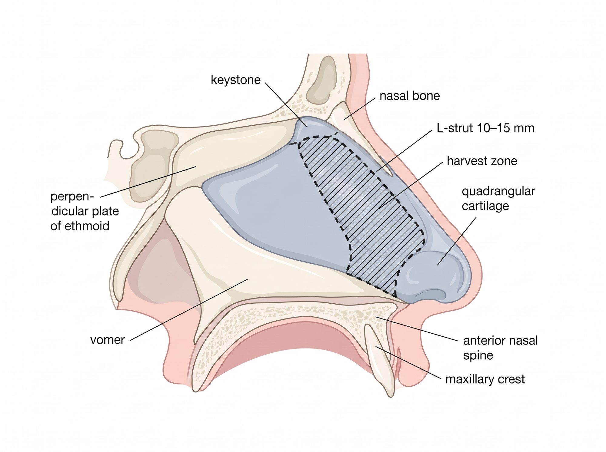 Sagittal section of the septum: quadrangular cartilage, perpendicular plate of the ethmoid, vomer, the 10–15 mm L-strut