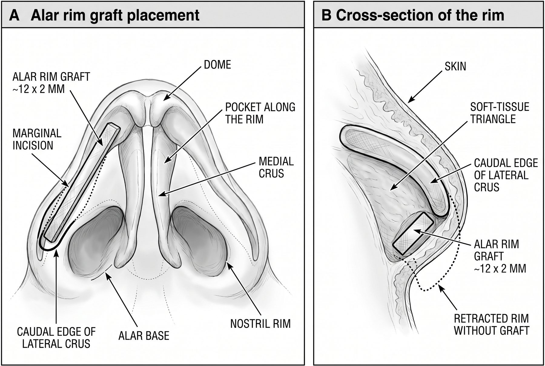 Alar rim graft: a ~12 × 2 mm cartilage strip placed through the marginal incision in a pocket along the nostril rim, caudal to the lateral crus, with a cross-section of the rim showing the graft and the retracted rim without it