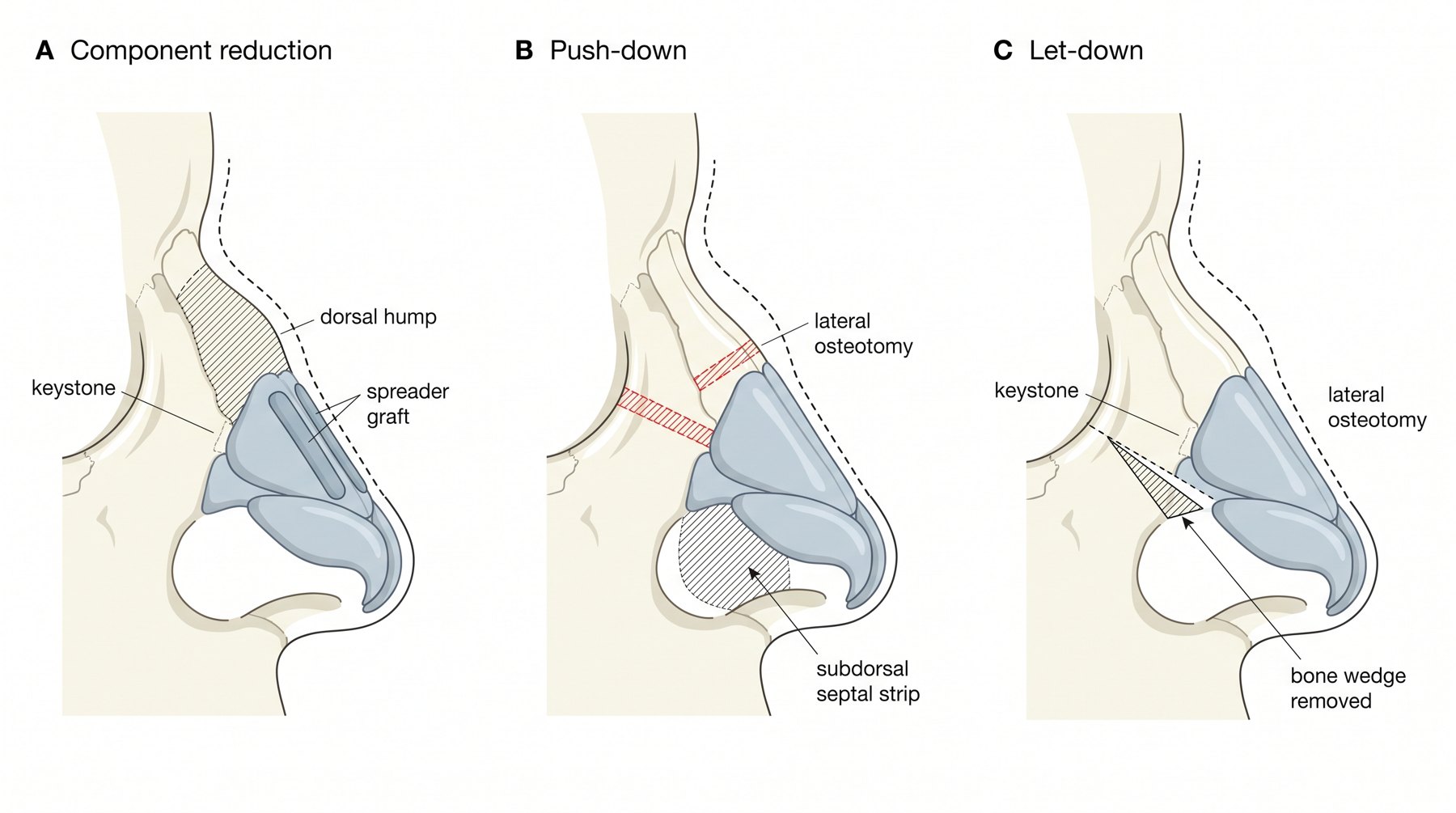 Three ways down a hump: component reduction with spreader grafts, push-down with a subdorsal septal strip, let-down with a bone wedge removed