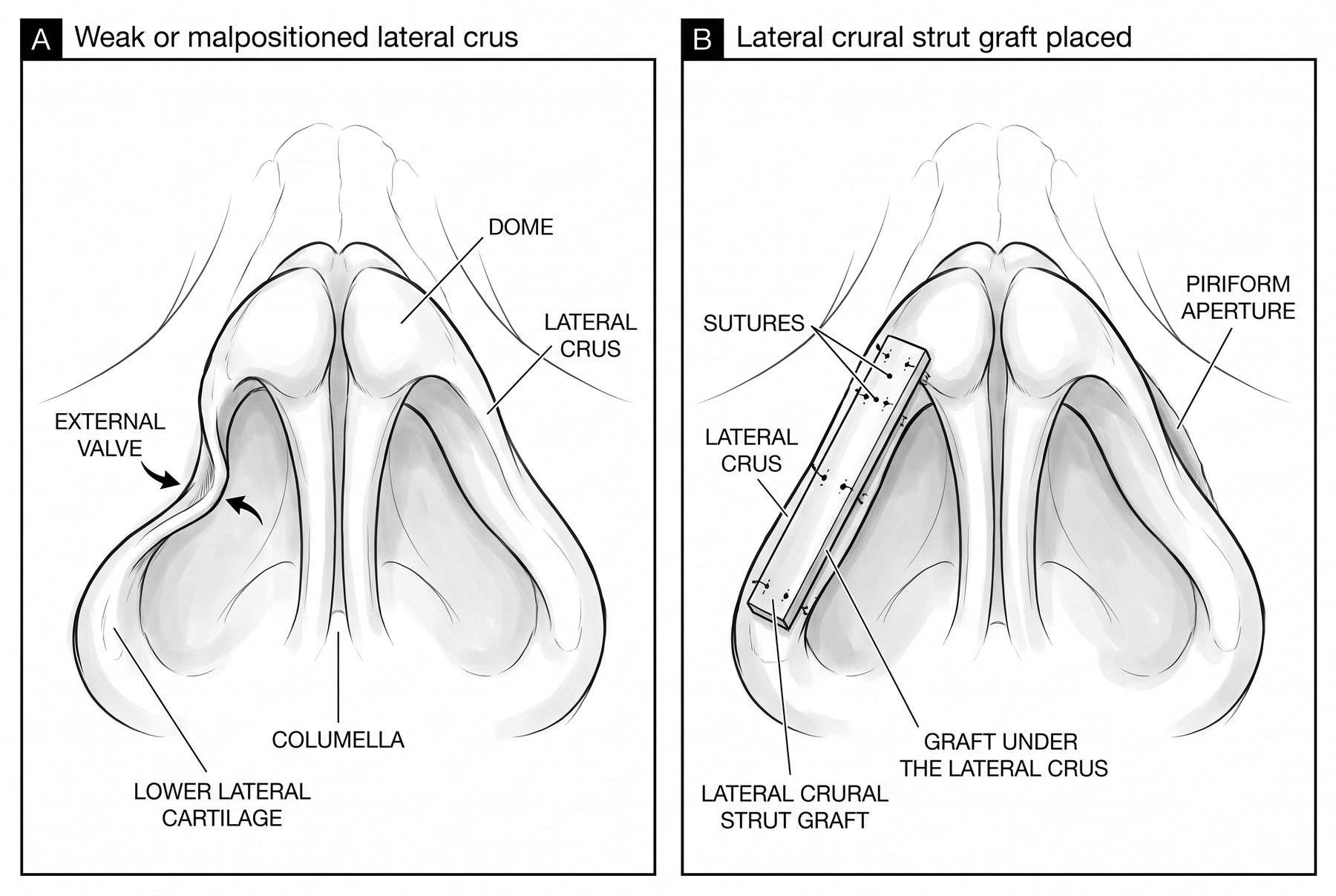 Lateral crural strut graft: a weak, buckled lateral crus with external valve collapse, then the strut sutured to the deep (vestibular) surface of the lateral crus out toward the piriform aperture