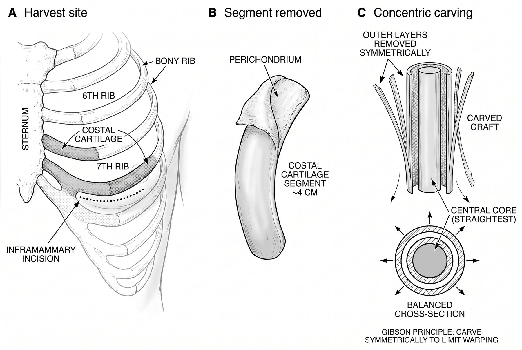 Rib cartilage harvest: inframammary incision over the 6th–7th costal cartilage, the ~4 cm segment with its perichondrium, and concentric carving to a balanced cross-section (Gibson principle) to limit warping