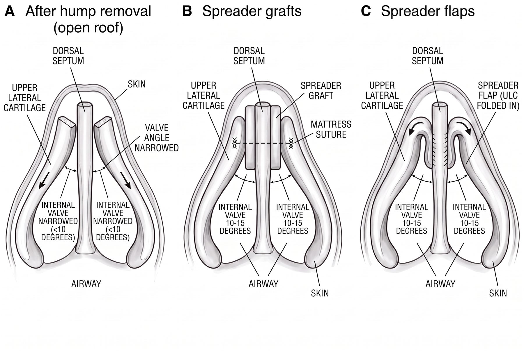 Coronal section at the internal valve: the open roof after hump removal, spreader grafts sutured between the dorsal septum and each upper lateral cartilage, and the spreader-flap alternative with the upper lateral cartilages folded in